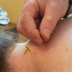 Dry Needling